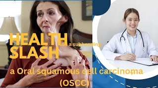 what is Oral squamous cell carcinoma OSCC  Health How to treat it [upl. by Tteraj]