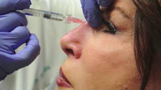 Nonsurgical Rhinoplasty [upl. by Stanly552]