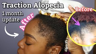 HOW I GREW MY EDGES IN 1 MONTH  Traction Alopecia [upl. by Nnylatsyrk382]