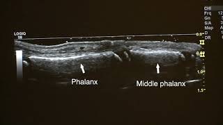 Ultralydundersøkelse av barn 2 proksimale interfalangealledd PIP2 longitudinal dorsal scan [upl. by Anauqahs]