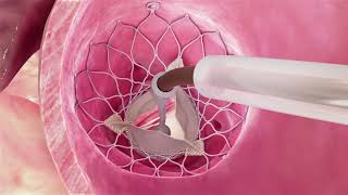 Evolut® Procedure for Aortic Stenosis Heart Valve Condition [upl. by Nnahgem]