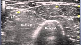 Median Nerve  elbow Sonoanatomy  QMH AED Ultrasound Casebook 2013 Video 10 [upl. by Ylecic]