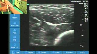 Ultrasound location of radial nerve at elbow [upl. by Alleram194]