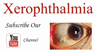 Xerophthalmia Introduction and Causes of Vitamin A Deficiency [upl. by Beverly631]