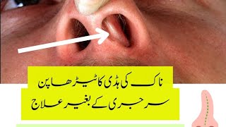 Deviated nasal septum treatment without surgery  DNS  Homeopathy [upl. by Yeneffit]