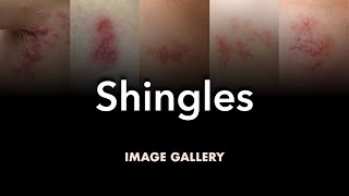 Shingles Herpes Zoster Image Gallery [upl. by Mich]