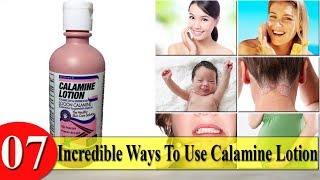 7 Incredible Ways To Use Calamine Lotion [upl. by Sudnor]