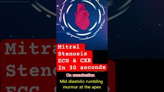 mitralvalve stenosis ecg xray shortnessofbreath cardiology mbbsstudent doctor [upl. by Simsar]