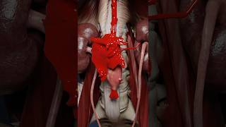 Abdominal aortic aneurysm rupture 3D animation with VOKA 3danatomy [upl. by Merc]