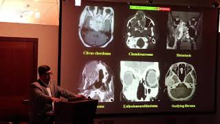 Aneurysmal bone cyst in skull base ABC 33 [upl. by Nilok]