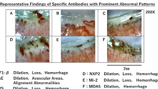 Capillaroscope Essentials5Rheumatology DrYoshihide Asano Dr Naoki Mugii Dr Toshihiko Komai [upl. by Hgielrac]