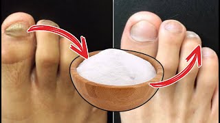 URGENT MIX THIS AND GOODBYE FUNGI ON NAILS Foot Fungus Natural Treatment [upl. by Brufsky]