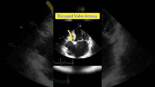 Tricuspid Valve Atresia  Echocardiography For Beginners echocardiogram shorts [upl. by Aniger390]