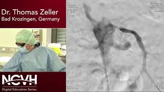 Professor Thomas Zeller Live Case Stenting of Ostial Stenosis of the SMA and Celiac Trunk Case [upl. by Kowalski]