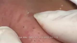 Highlight Professional blackhead popping at its best  GÀ SPA [upl. by Aikemot]