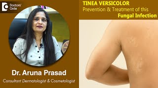 White Patches on Skin Is it TINEA VERSICOLOR  Is it Fungal  DrAruna Prasad  Doctors Circle [upl. by Atekihc878]