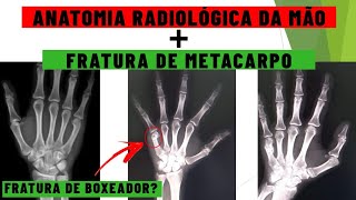 Anatomia radiológica da mão  Fratura de metacarpo  Anatomia da mão no RaioX  Medicina Geral [upl. by Willms]