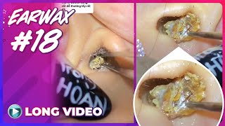 EP 18 Earwax ASMR Surprised by dirty objects in ears that have not been cleaned for a long time [upl. by Aldus]