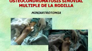 Dr David González Aceves OSTEOCONDROMATOSIS DE RODILLA wmv [upl. by Llewsor]