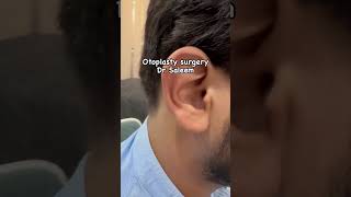 Otoplasty surgery for ear reshaping amp prominent ears otoplasty otoplastysurgery [upl. by Johppah912]