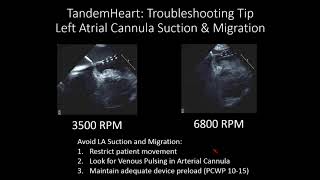 Impella Tandem Heart ECMO StepbyStep and Troubleshooting  Navin Kapur MD [upl. by Assiralk681]