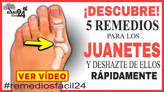 Descubre los 5 Remedios Caseros para los Juanetes y Deshazte de Ellos  Juanetes en los Pies [upl. by Bat]