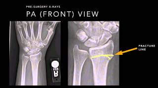 Wrist Fracture Xrays [upl. by Naggem]