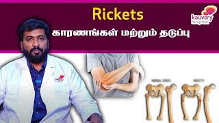 Rickets  Causes amp Prevention  Tamil [upl. by Abdella]