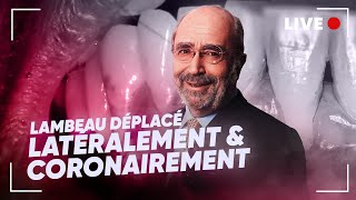 En Direct  🔴 Lambeau déplacé latéralement amp coronairement 🦷 [upl. by Olzsal]