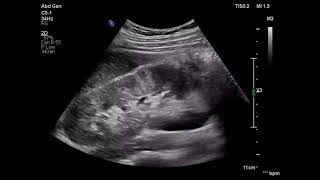 Acute pyelonephritis ultrasound patient with flank pain fever ARDMS sonography [upl. by Ahsea610]