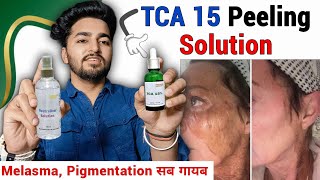 Tca 15 Chemical Peel Review  TCA 15 Peel How to Use  At Home Chemical Peel [upl. by Olram331]