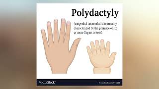 Polydactyly [upl. by Bevan]