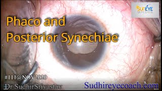 Phaco and Posterior Synechiae  DR SUDHIR SRIVASTAVA [upl. by Tarfe]