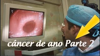 síntomas del cáncer de ano la enfermedad silenciosa que debes conocer Parte 2 [upl. by Roe]