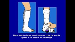 traumatologie Rappel sur les fractures des membres [upl. by Anaiad]