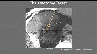 Neurosurgery On the Go Utilizing Radiosurgery for Thalamotomy [upl. by Nayrbo]