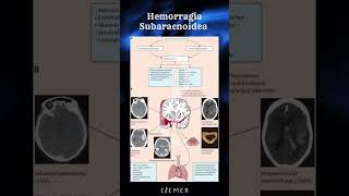 🧠 Fisiopatología de la Hemorragia Subaracnoidea 🧠 CIEMER FOAMed [upl. by Sorips]