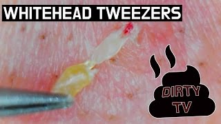 7 Pull out White heads with Tweezers Whiteheads Close up 300X  Blackheads white heads Removal [upl. by Elder]