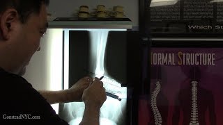 Severe swollen ankle pain  FIXED with Gonstead Chiropractic [upl. by Tomkiel283]