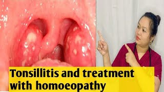 Tonsillitis😱😱signs amp symptoms and its treatment with homoeopathy ✅🍀💯 [upl. by Kroo]