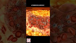 Atherosclerosis 🩸 [upl. by Yrellih17]