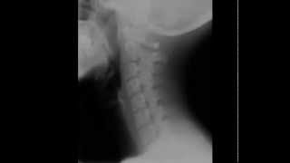 Cervical Spine Radiology Tutorial [upl. by Eleynad]