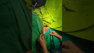 Advanced LASER Haemorrhoids Piles Treatment by Dr Hina Khan [upl. by Merril]