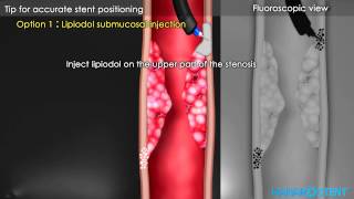 Hanaro Oesophageal Stents Demonstration Video [upl. by Nnylatsirk442]