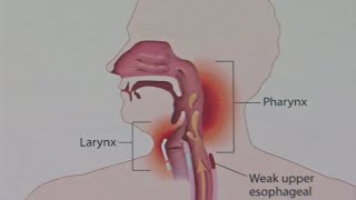 Good Question What Causes Laryngitis [upl. by Manup]