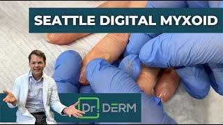 Digital Myxoid from Seattle  Dr Derm [upl. by Nylessoj500]