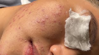 Acne Treatment Bo Nguyễn Spa  Blackheads On Tween Face 2024FULL [upl. by Kathleen529]