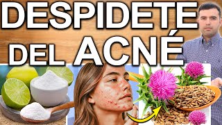 ELIMINA EL ACNE PARA SIEMPRE  Como Eliminar Los Granos Espinillas y Curar El Acné En 1 Semana [upl. by Blanka]