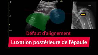 Luxation Postérieure de lÉpaule Échographie Glénohumérale Posterior shoulder dislocation [upl. by Selegna]