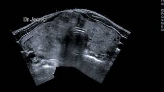 Huge multinodular goiter of thyroid ultrasound and color Doppler video thyroid enlargement [upl. by Alliscirp]